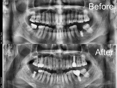Before and after dental implant results at Yonsei JW Dental Clinic, improved jaw structure visible