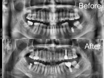 Before and after dental implant results at Yonsei JW Dental Clinic, improved jaw structure visible