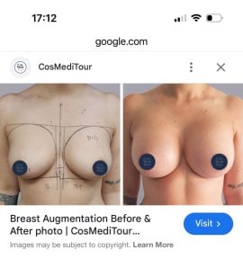 Результати до і після збільшення грудей у CosMediTour, покращена форма і розмір грудей