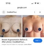 Результати до і після збільшення грудей у CosMediTour, покращена форма і розмір грудей