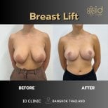 Результати до і після підтяжки грудей в ID Clinic Bangkok, покращена форма грудей
