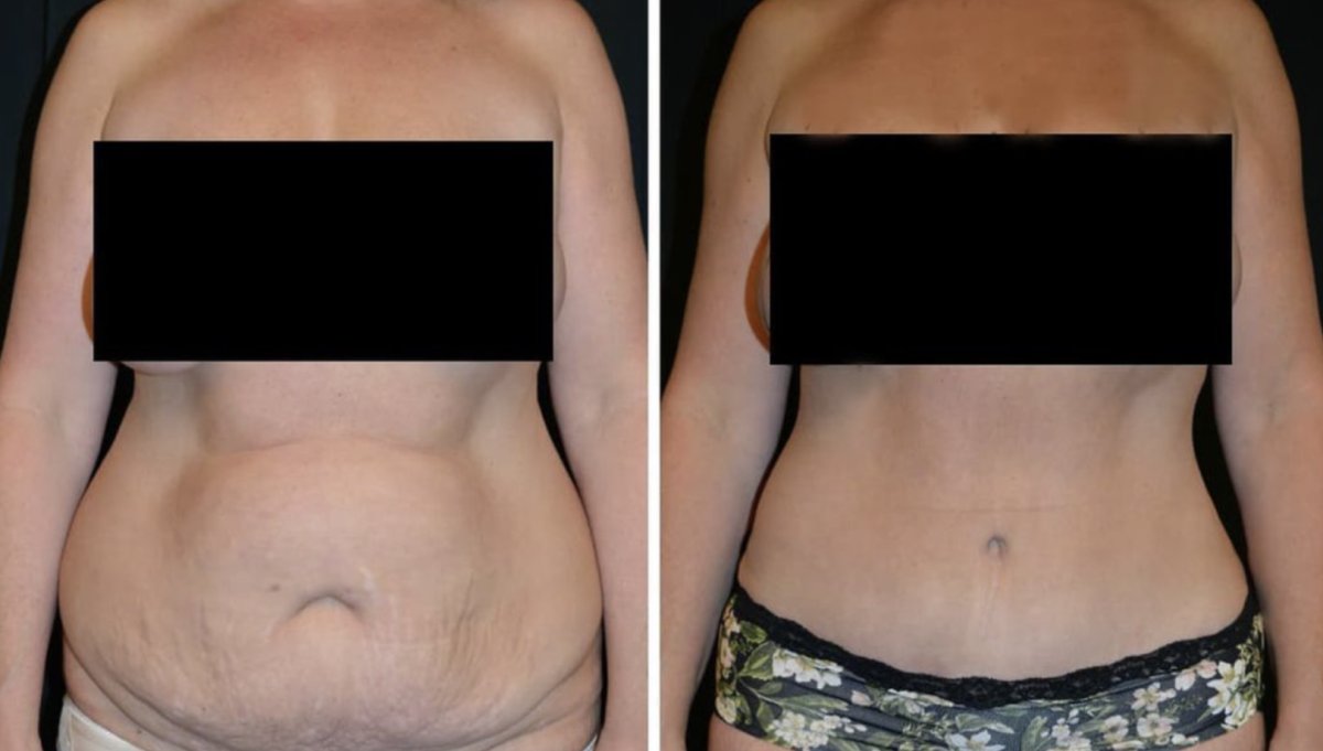 Resultados de liposucción antes y después en Esthétique du Nord, mejora visible del abdomen