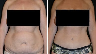 Before and after liposuction results at Esthétique du Nord, visible abdominal contour improvement