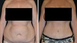 Before and after liposuction results at Esthétique du Nord, visible abdominal contour improvement