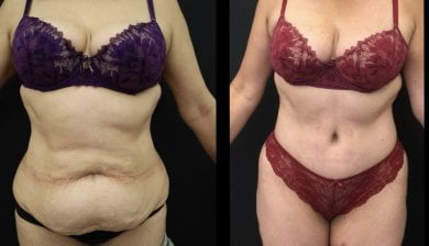 Before and after liposuction results at Esthétique du Nord, improved abdominal contour