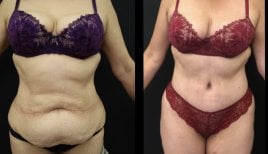 Before and after liposuction results at Esthétique du Nord, improved abdominal contour