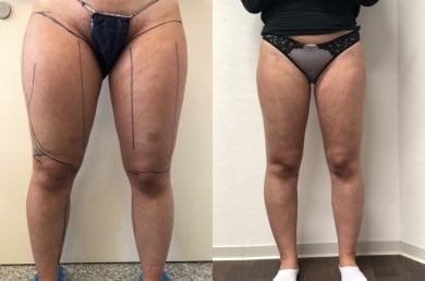 Before and after liposuction results at Esthétique du Nord, slimmer thighs and improved contour