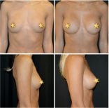 Before and after breast augmentation with silicone implants at Esthétique du Nord, visible result