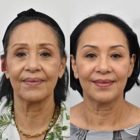 Vorher-nachher-Ergebnis Halsstraffung bei BKFL Clinic, sichtbare Hautverjüngung