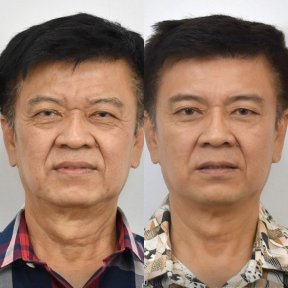 Vorher-nachher-Ergebnis Halsstraffung bei BKFL Clinic, sichtbare Verjüngung