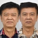 Vorher-nachher-Ergebnis Halsstraffung bei BKFL Clinic, sichtbare Verjüngung