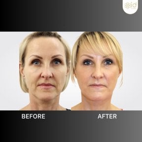 Before and after mini facelift results at ID Clinic Bangkok, visible facial rejuvenation