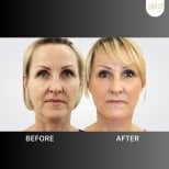Before and after mini facelift results at ID Clinic Bangkok, visible facial rejuvenation