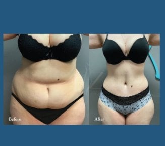 نتائج شد البطن قبل وبعد في ID Clinic Bangkok – تحسين واضح لشكل البطن