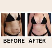نتائج شد البطن قبل وبعد في ID Clinic Bangkok – تحسين شكل البطن
