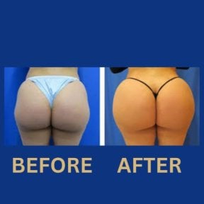 Before and after Brazilian Butt Lift results at ID Clinic Bangkok, enhanced buttock contour
