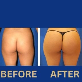 Before and after Brazilian Butt Lift results at ID Clinic Bangkok, enhanced buttock contour