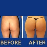 Before and after Brazilian Butt Lift results at ID Clinic Bangkok, enhanced buttock contour