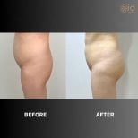 Before and after Brazilian Butt Lift results at ID Clinic Bangkok, enhanced buttock contour