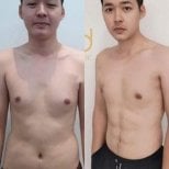 Before and after 360 liposuction results at ID Clinic Bangkok, improved male body contour