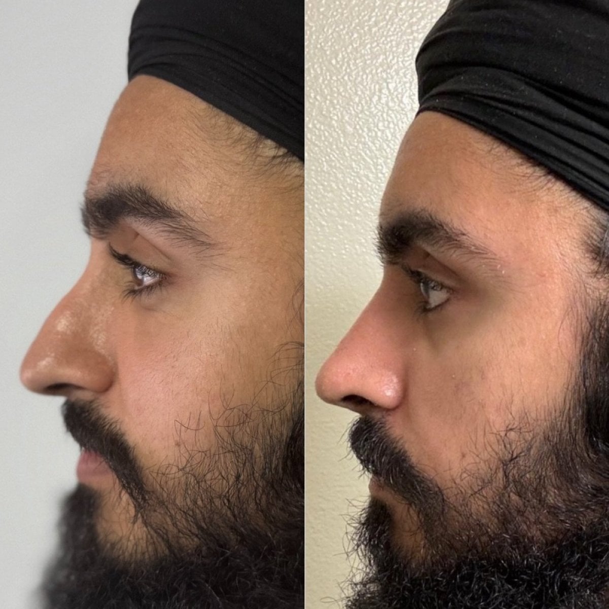 Resultado de rinoplastia antes y después en Marroquín & Sandoval Plastic Surgery Clinic, remodelación nasal