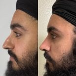 Before and after rhinoplasty result at Marroquín & Sandoval Plastic Surgery Clinic, nose reshaping