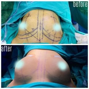 نتائج قبل وبعد جراحة إعادة بناء الثدي في مستشفى هيسار إنتركونتيننتال