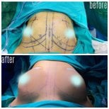 نتائج قبل وبعد جراحة إعادة بناء الثدي في مستشفى هيسار إنتركونتيننتال