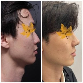 Результаты до и после риносептопластики в VG Plastic Surgery, улучшенный профиль носа