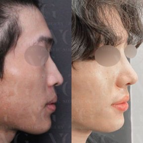 Результаты ринопластики до и после в VG Plastic Surgery, улучшенная форма носа и профиль