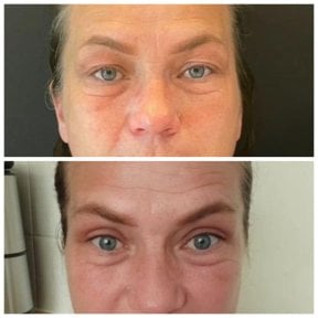 Before and after blepharoplasty results at Soraca Med Istanbul, eyelid correction improvement