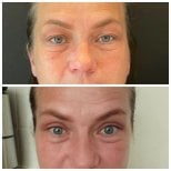 Before and after blepharoplasty results at Soraca Med Istanbul, eyelid correction improvement