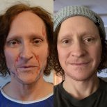 Vorher-nachher-Ergebnis der Brauenlifting bei Dr. Safa Manav Clinic, sichtbare Stirnstraffung