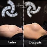 Vorher-nachher-Ergebnis Brustvergrößerung in der Alexandre Aguilera Klinik, verbesserte Brustform