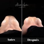 Vorher-nachher-Ergebnis Brustvergrößerung in der Alexandre Aguilera Klinik, mehr Volumen