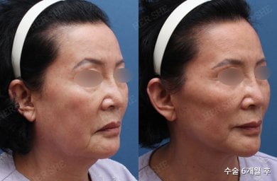 Результаты до и после SMAS-лифтинга в HERSHE Plastic Surgery Korea, омоложение лица