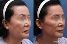 Результаты до и после SMAS-лифтинга в HERSHE Plastic Surgery Korea, омоложение лица