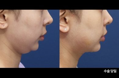 Результаты до и после подтяжки шеи в HERSHE Plastic Surgery Korea, улучшен контур челюсти