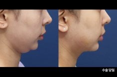 Результаты до и после подтяжки шеи в HERSHE Plastic Surgery Korea, улучшен контур челюсти