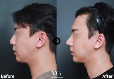 Результаты ринопластики до и после в VG Plastic Surgery, улучшенный профиль носа у мужчины