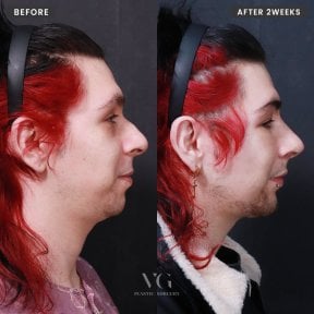Результаты ринопластики до и после в VG Plastic Surgery, улучшенный профиль носа через 2 недели