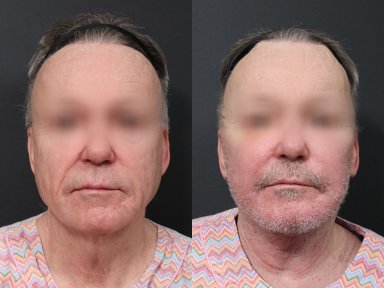 Результаты до и после подтяжки шеи в RNWOOD Plastic Surgery, видимый лифтинг шеи