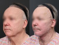 Результаты до и после подтяжки шеи в RNWOOD Plastic Surgery, видимый лифтинг шеи