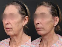 Результаты до и после подтяжки шеи в RNWOOD Plastic Surgery, заметное подтяжение шеи