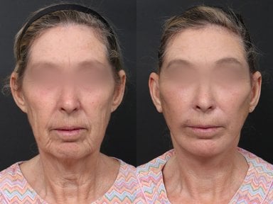 Результаты до и после подтяжки шеи в RNWOOD Plastic Surgery, видимый лифтинг кожи