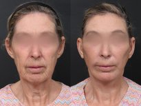 Результаты до и после подтяжки шеи в RNWOOD Plastic Surgery, видимый лифтинг кожи
