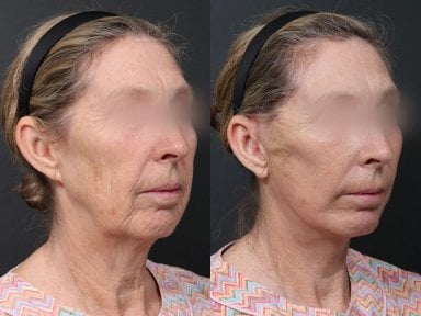 Результаты до и после deep plane SMAS лифтинга в RNWOOD Plastic Surgery, омоложение лица