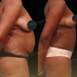 Vorher-nachher-Ergebnis Mommy Makeover bei Memorial Göztepe Hospital, verbesserte Körperform