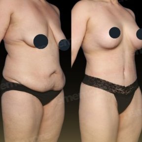 Vorher-nachher-Ergebnis Mommy Makeover bei Memorial Göztepe Hospital, verbesserte Körperform
