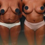 Vorher-nachher-Ergebnis Mommy Makeover bei Memorial Göztepe Hospital, Körperkontur verbessert